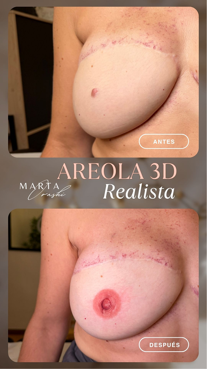 Areola-3D-antes-y-despues-1-1.png