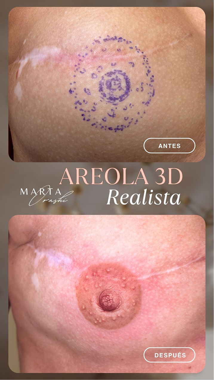 Areola-3D-antes-y-despues-10-1.png